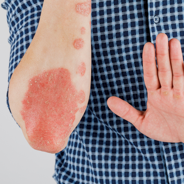 Adult Plaque Psoriasis