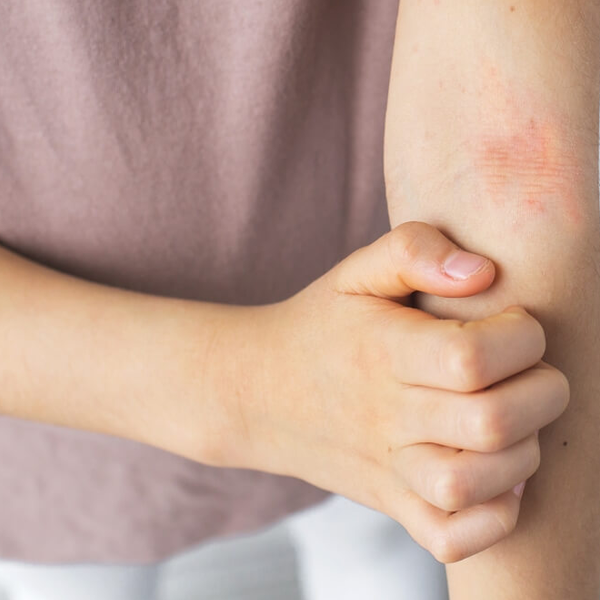 Pediatric Atopic Dermatitis
