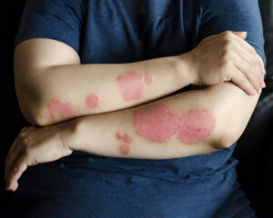Weeping Eczema